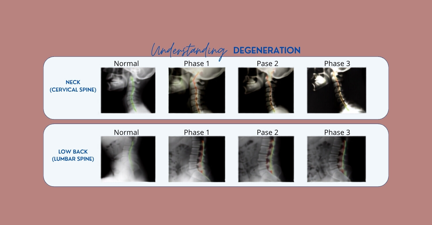 Examples of progressive degenerative changes in the cervical and lumbar spine